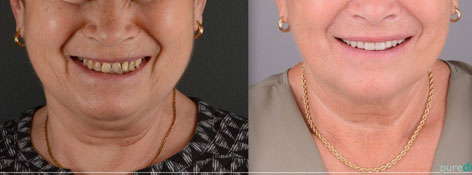 Celková rekonstrukce horní čelisti s ortodontickým předléčením